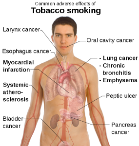 570px-Adverse_effects_of_tobacco_smoking.svg
