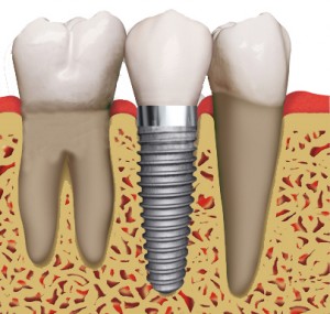 Dental implant @dentistportorange.com