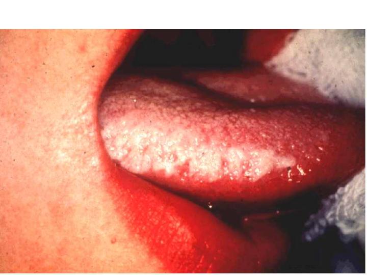 Hairy Tongue Leukoplakia 75