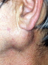 Swelling of parotid gland Â© W P Smith