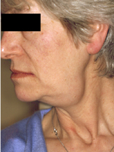 Swelling of the submandibular gland Â© W P Smith