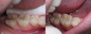 Decayed tooth filled with composite bonding material