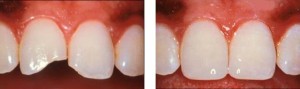 The edges of the teeth are fractured and restored with composite bonding material