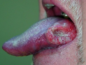 Oral cancer lesion at the side of the tounge