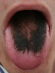 Black hairy tongue