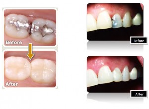 Old amalgam filling replaced with new composite bonding material to resemblance natural teeth
