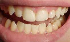 Gap is now closed with composite bonding material. Veneers can also be used here.