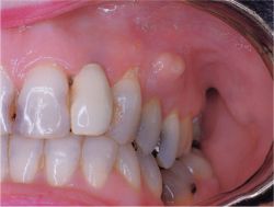 Periodontal abscess Â© The Free Dictionary