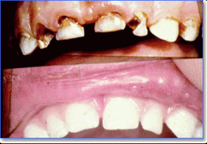 Nursing bottle decay  in a young child, composite bonding is used to build up the crown