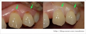 Cervical abrasion is seen on the neck of the tooth, notice the green arrows, those abraded areas are restored with composite bonding material