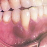 Kaposi sarcoma Â© SoftDental