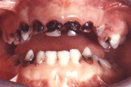 tooth decay in children @ thebuczkowskiblog.blogspot.com