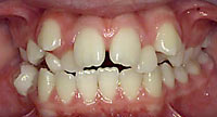 Crooked teeth @ abedorthodontics.com