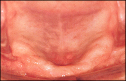 Atrophy of maxillary alveolar ridge