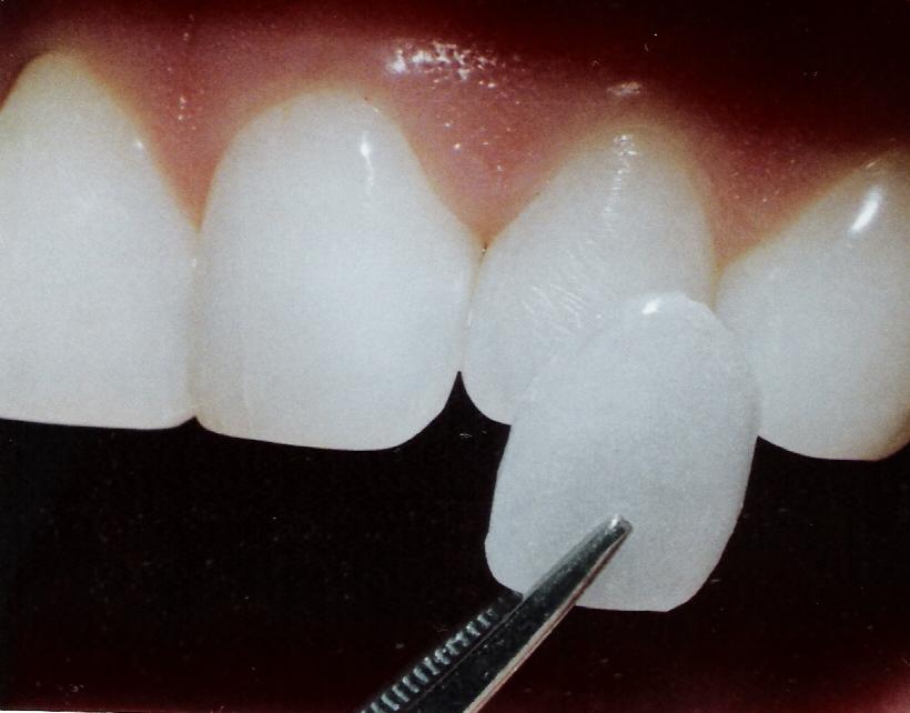 Laminates And Veneers. Dental porcelain veneers are