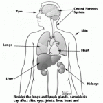 Sarcoidosis disease is a multisystemic disease, affecting all the body systems
