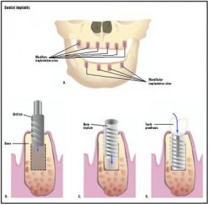 Dental implant Â© GGS Inc. & Answers Corporation
