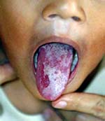 Mouth Ulcer seen on the tounge in a young child