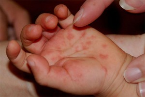 Lesions seen on the palm of a young child