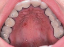 Mouth ulcers seen on the roof of the mouth