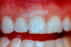 Image result for what causes pale gums