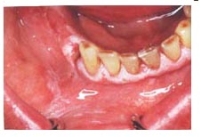 Leukoplakia Â© stop-smoking-secrets.com