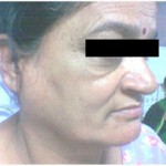 Patient here has swollen parotid slaivary glands due to sarcoidosis disease