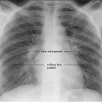 routine chest x ray, nodules can be seen in sarcoidosis disease