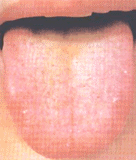 Yellow Hairy Tongue Â© Chinese Medicine Gem
