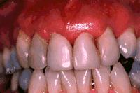 Advanced Periodontitis Â© PIC