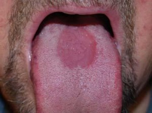 Median rhomboid glossitis