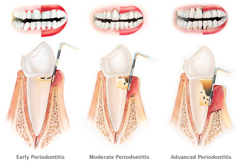 Levels of chronic periodontitis Â© Stanley Dentistry