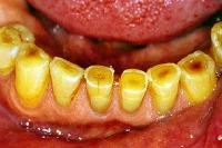 Tooth wear Â© Medscape