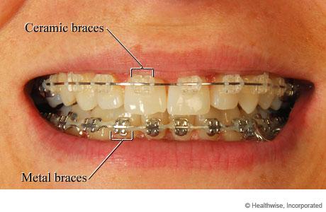 teeth braces for adults. Ceramic or metal races