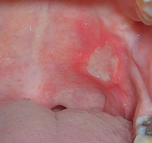 Aphthous ulcer in the back of the mouth