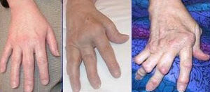 Arthrite rhumatoide Source: http://nihseniorhe...