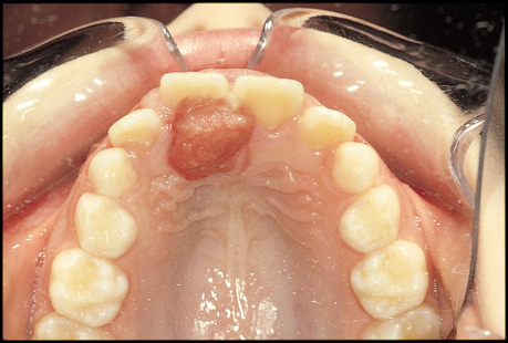 pyogenic granuloma removal