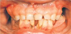 Hereditary gingival fibromatosis Â© 2009 Farlex, Inc.