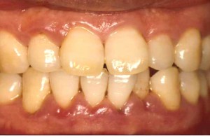 Pregnancy gingivitis