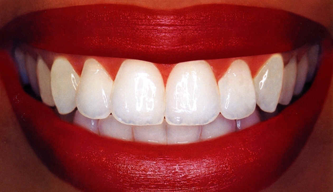 White Teeth