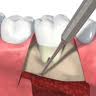 Gingival flap