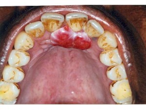 oral pyogenic granuloma