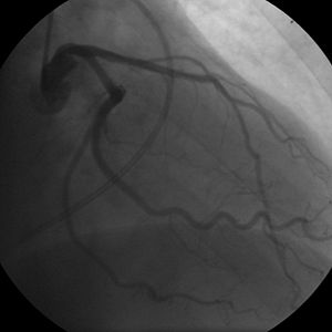 Coronary angiogram of a woman