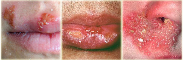 Cold Sore Picture Image on MedicineNet.com