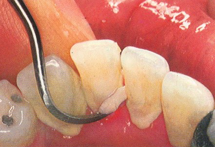 Periodontal Scaling Scam