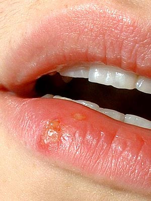 genital herpes mouth. herpes mouth blister.