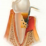 periodontitis