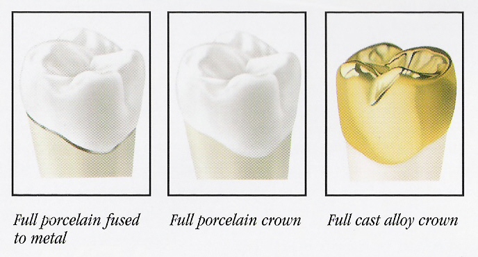 pictures tooth crown