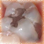 Fractured amalgam restoration