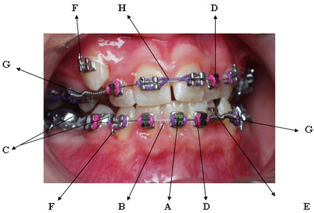 Teeth Needing Braces